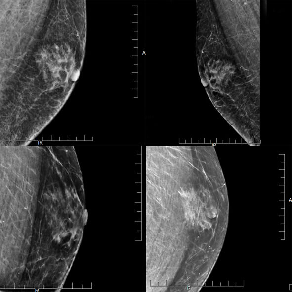 Breast mammogram showed bilateral benign gynecomastia, with the right