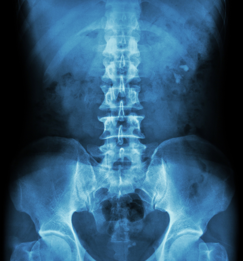 enlarged prostate x ray